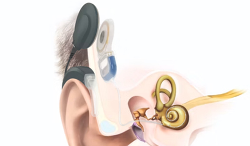 Zoom: Grafische Darstellung eines Cochlea-Implantats mit Elektrode in der Hörschnecke.