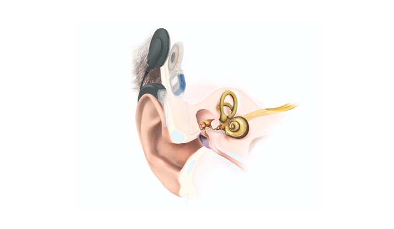 Grafische Darstellung eines Cochlea-Implantats mit Elektrode in der Hörschnecke.